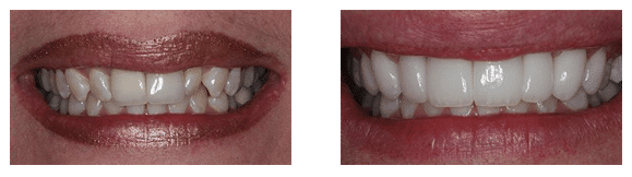 8 Anterior Teeth Before & After Marietta Smile Makeover Before & After
