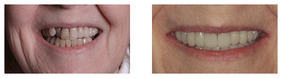 Full Mouth Restoration Before & After Marietta Smile Makeover Before & After