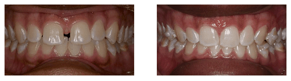 Invisalign Before & After Marietta Smile Makeover Before & After