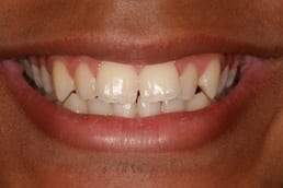 Inman Aligner in Atlanta