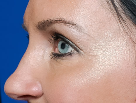 After BOTOX® treatment