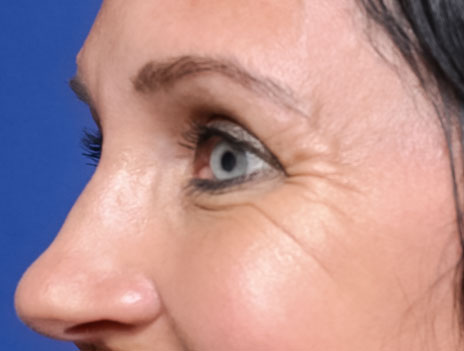 Before BOTOX® treatment