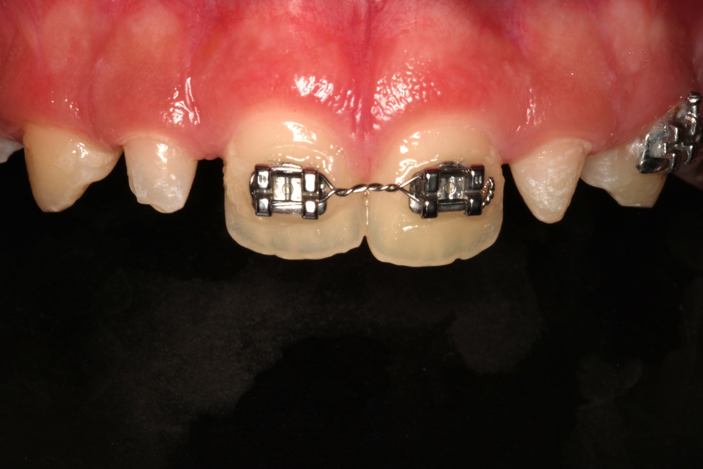 Before 3D Printed Veneers
