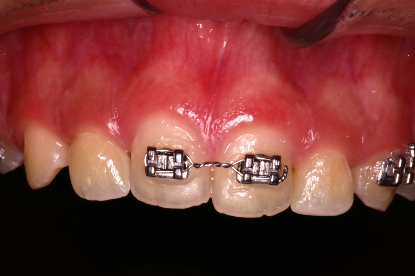 After 3D Printed Veneers