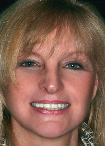 Before detail, Eight Upper Veneers & Six Lower Veneers, Diane