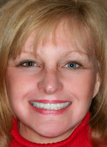 After detail, Eight Upper Veneers & Six Lower Veneers, Diane