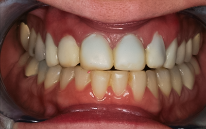 Before Eight Upper Veneers & Six Lower Veneers, Diane