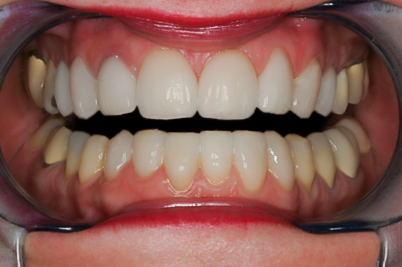Eight Upper Veneers & Six Lower Veneers, Diane