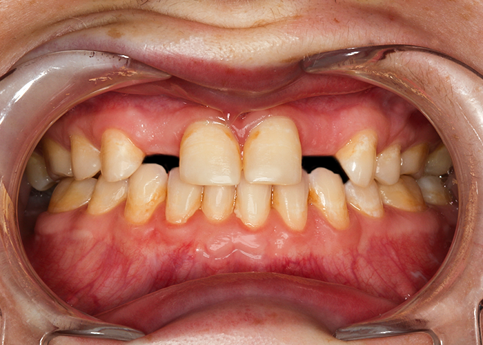 Before Smile Makeover Veneer, Implants & Crowns, Allie
