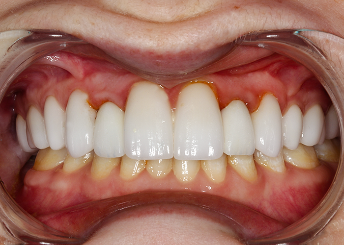 Smile Makeover Veneer, Implants & Crowns, Allie