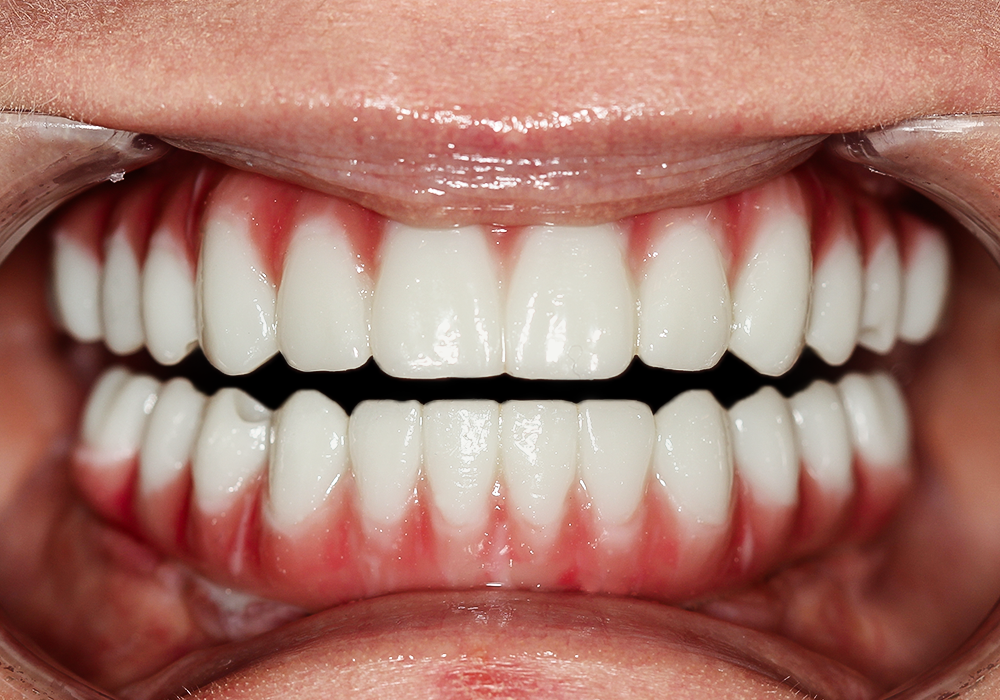 Teeth in a Day All on Six, Amy