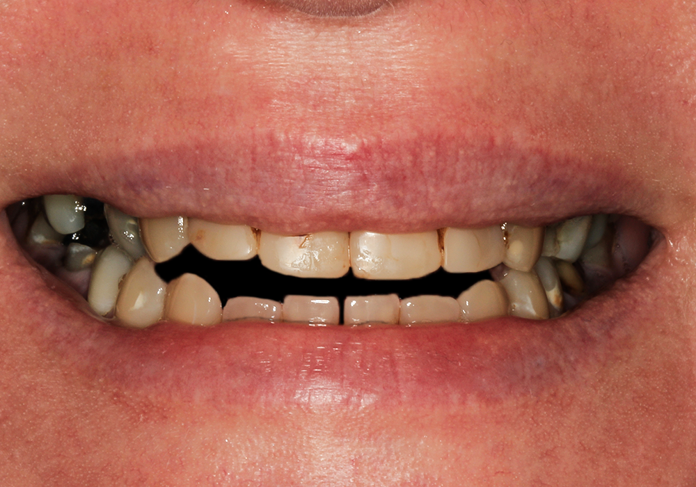 Before detail, Teeth in a Day All on Six, Amy