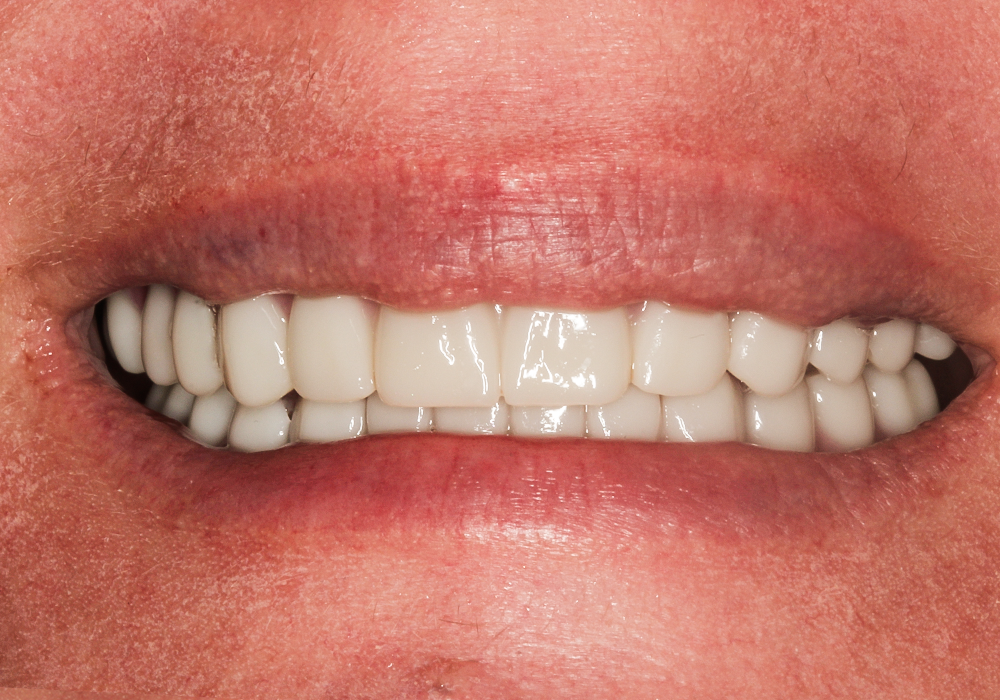 After detail, Teeth in a Day All on Six, Amy