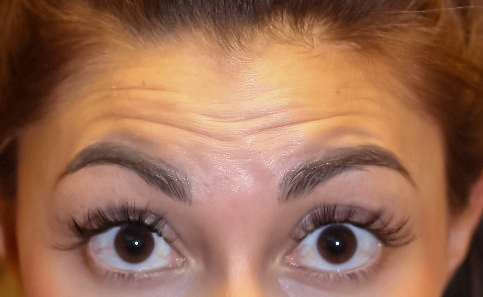 Before BOTOX®, Angelia