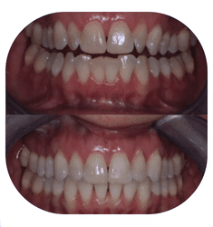 Before Annette's Smile-Correcting Invisalign®