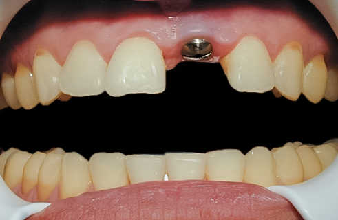 Before Anterior Implant