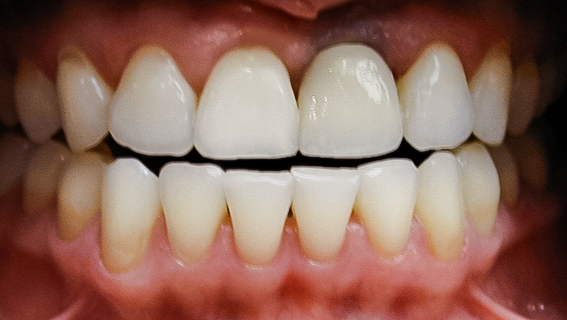 Anterior Implant