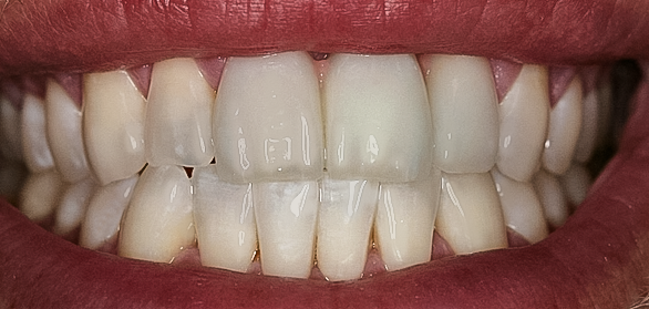 Before Bridges Anterior Three Unit Bridge