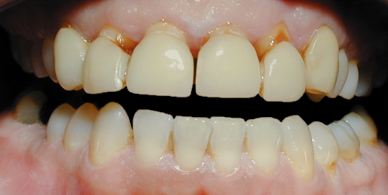 Before Eight Porcelain Veneers, Bejie
