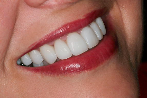 Eight Porcelain Veneers, Bejie