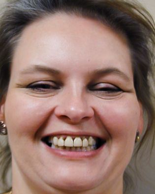 PowerPoint case photo, Eight Porcelain Veneers, Bejie