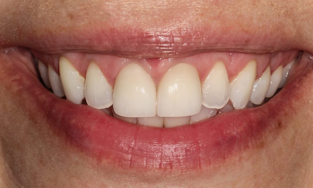 After Crowns, Callie / Two Anterior Crowns