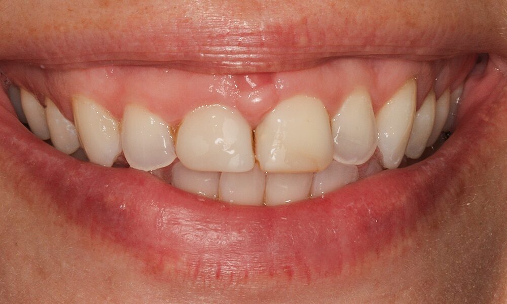 Before Crowns, Callie / Two Anterior Crowns