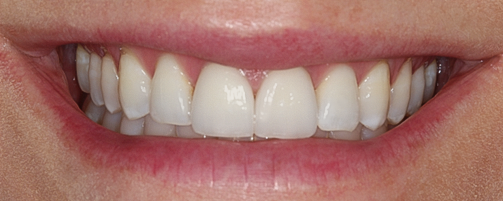 After detail, Two Central Veneers - Cara
