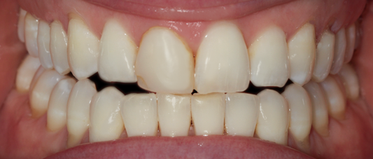 Before Two Central Veneers - Cara