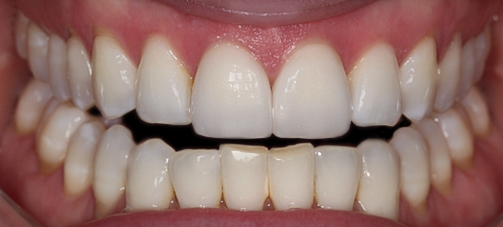 Two Central Veneers - Cara