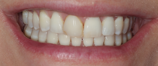 Before detail, Two Central Veneers - Cara