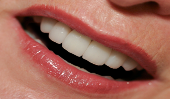 Ten Upper Veneers to Replace Old Crowns & Discolored Teeth, Carole