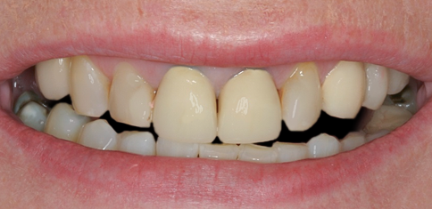 Before Ten Upper Veneers to Replace Old Crowns & Discolored Teeth, Carole