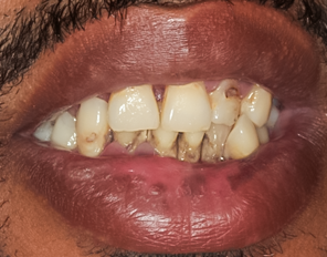 Before detail, Implant Supported Upper and Lower Denture, Cedric