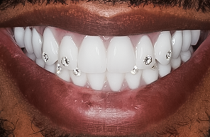After detail, Implant Supported Upper and Lower Denture, Cedric