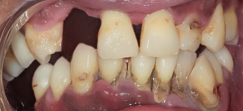 Before Implant Supported Upper and Lower Denture, Cedric