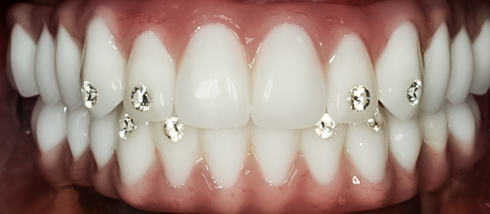 Implant Supported Upper and Lower Denture, Cedric