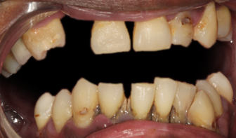 Before detail, Implant Supported Upper and Lower Denture, Cedric
