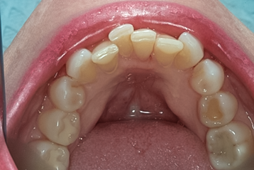 Before detail, Clear Aligner, Lower Front Teeth