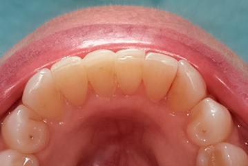 After detail, Clear Aligner, Lower Front Teeth
