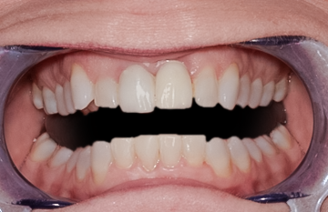After Clear Aligner, Lower Front Teeth