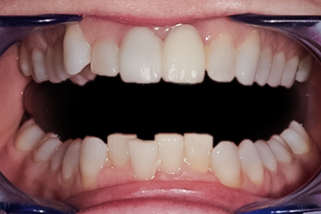 Before Clear Aligner, Lower Front Teeth