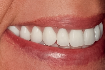 After detail, Complete Upper Implant Reconstruction, 54-YEAR-OLD Female