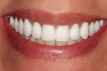Complete Upper Implant Reconstruction, 54-YEAR-OLD Female