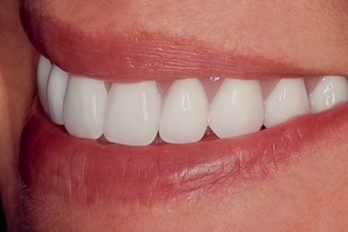 Before detail, Complete Upper Implant Reconstruction, 54-YEAR-OLD Female