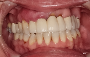 Before Complete Upper Implant Reconstruction, 54-YEAR-OLD Female