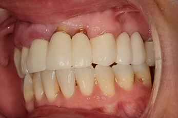 After detail, Complete Upper Implant Reconstruction, 54-YEAR-OLD Female
