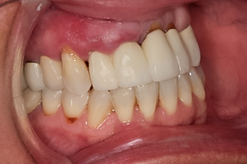 PowerPoint case photo, Complete Upper Implant Reconstruction, 54-YEAR-OLD Female
