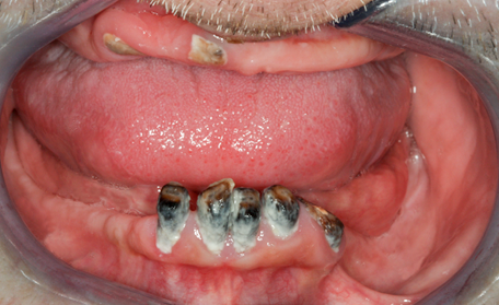 Before Complete Upper & Lower Denture