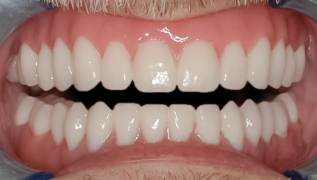 After Complete Upper & Lower Denture